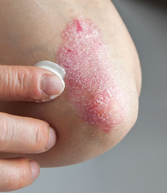 A psoriasis rash