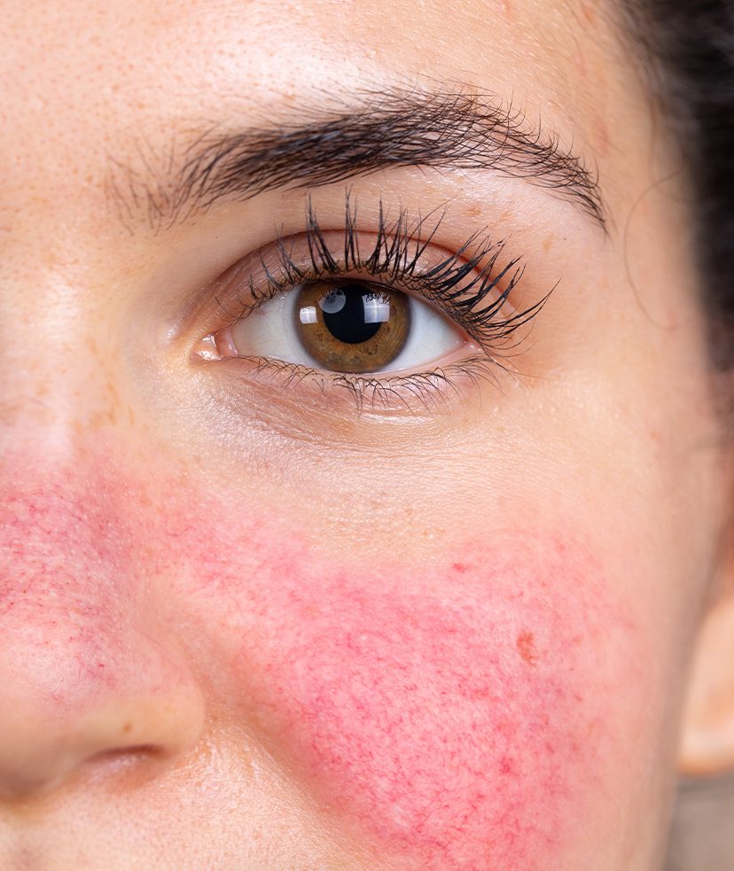 rosacea