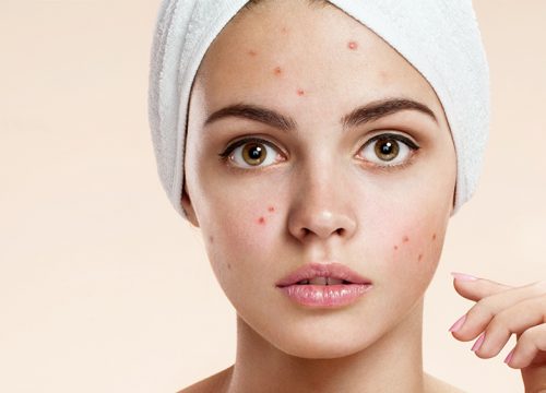 Woman with acne scars on her face