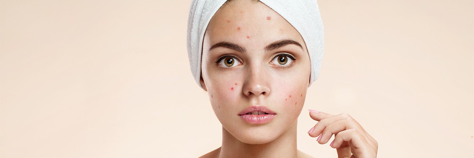 Acne Scarring