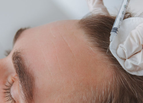 Man receiving CIT hair treatments