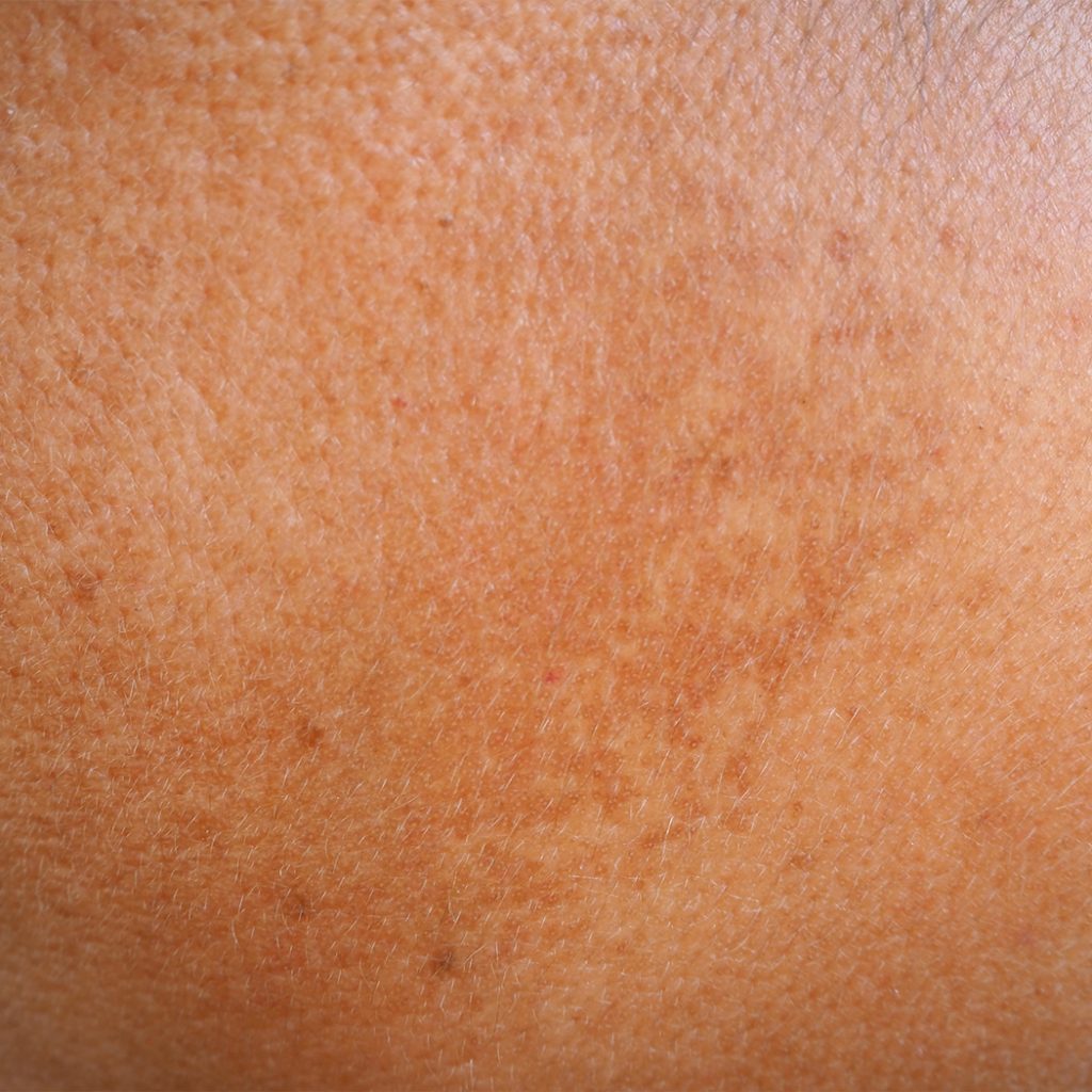 Hyperpigmentation