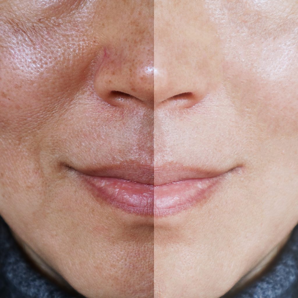 Before and after image of a woman's face