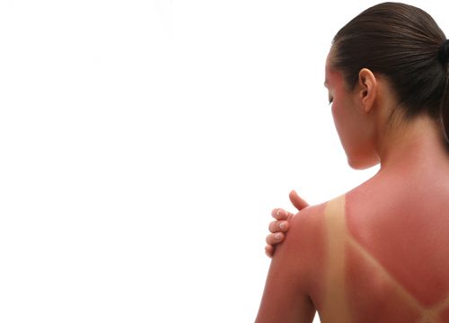 Woman with sun damage on her back