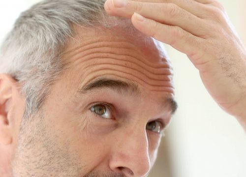 Older man dealing with hair loss