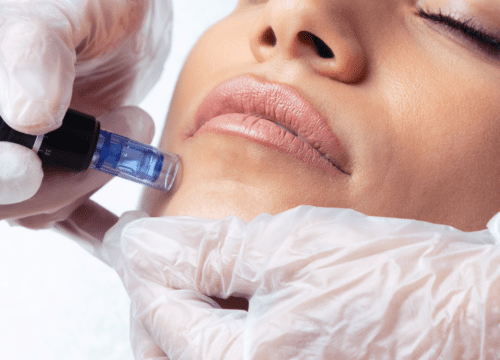 Microneedling: A Skin Revival Procedure