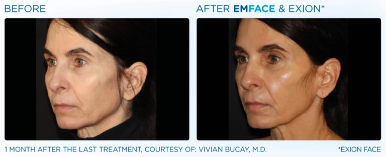 Emface_Exion_PIC_BA-card-face-female-102_ENUS100