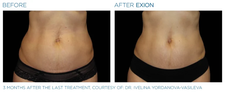 Exion_PIC_Ba-card-abdomen-female-050_Body_ENUS100