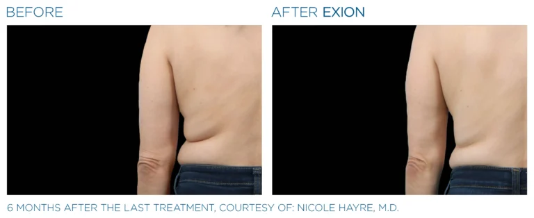 Exion_PIC_Ba-card-back-female-036_Body_ENUS100