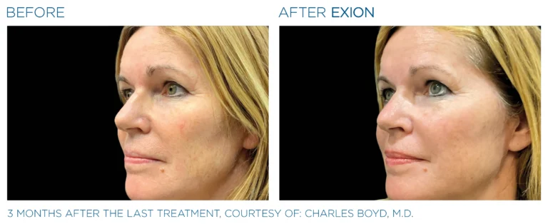Exion_PIC_Ba-card-face-female-002_Face_ENUS100