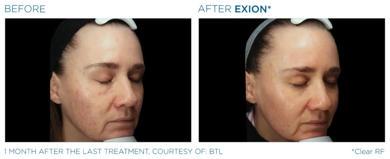 Exion_PIC_Ba-card-face-female-093_ENUS100