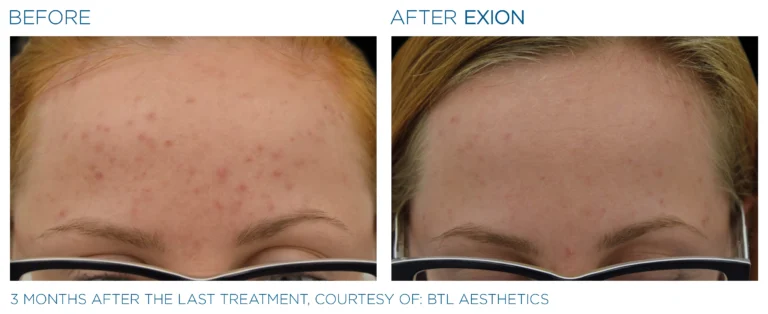 Exion_PIC_Ba-card-forehead-female-064_FRF_ENUS100