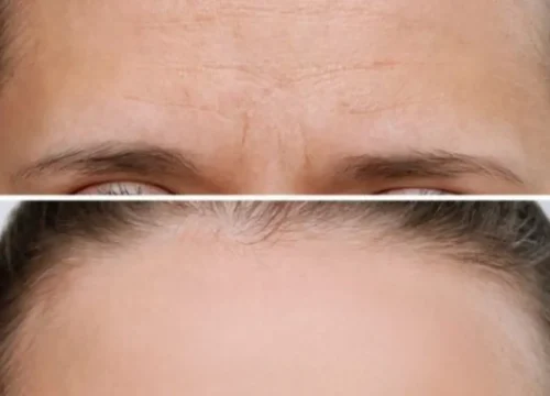 botox for forehead wrinkles