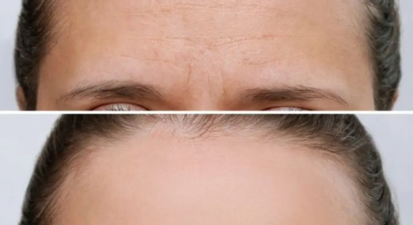Botox for Forehead Wrinkles: How It Works, Benefits, and What to Expect