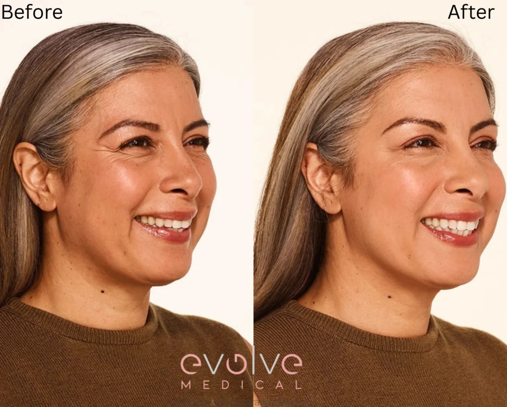 delfina before after botox