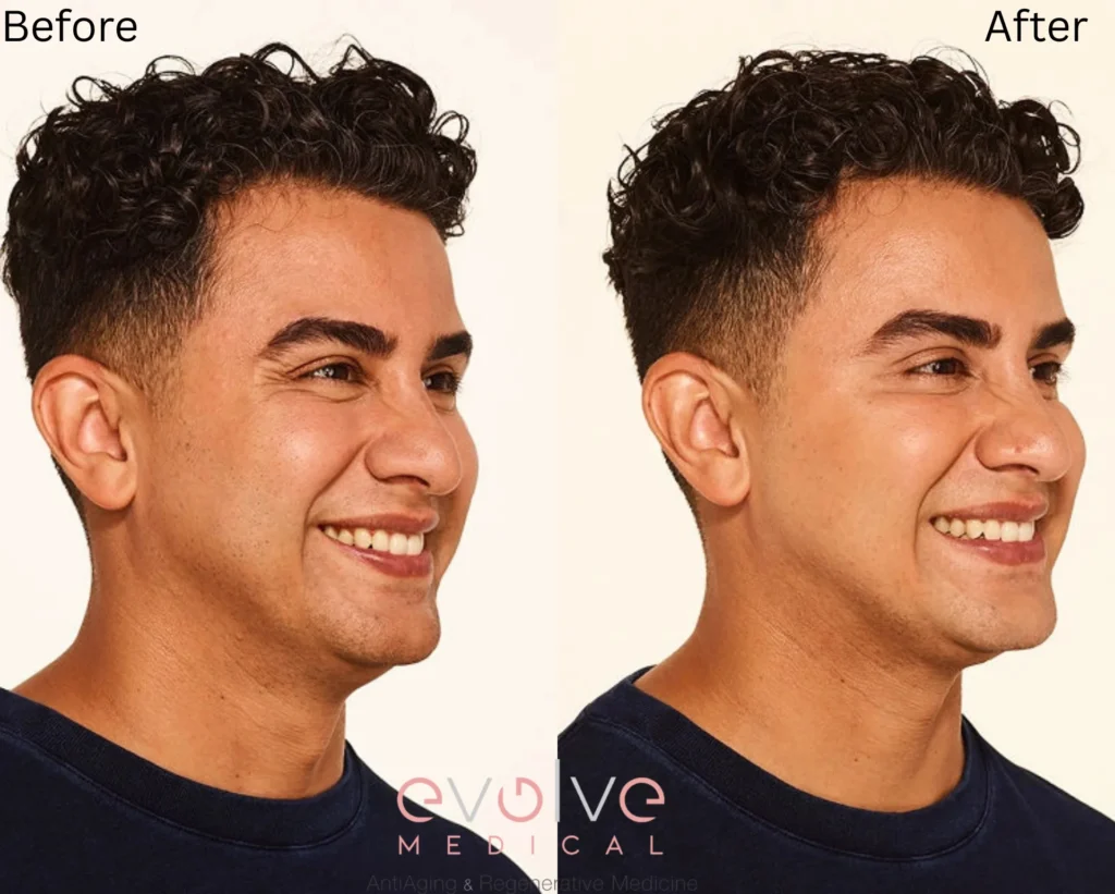 jeffrey before after botox