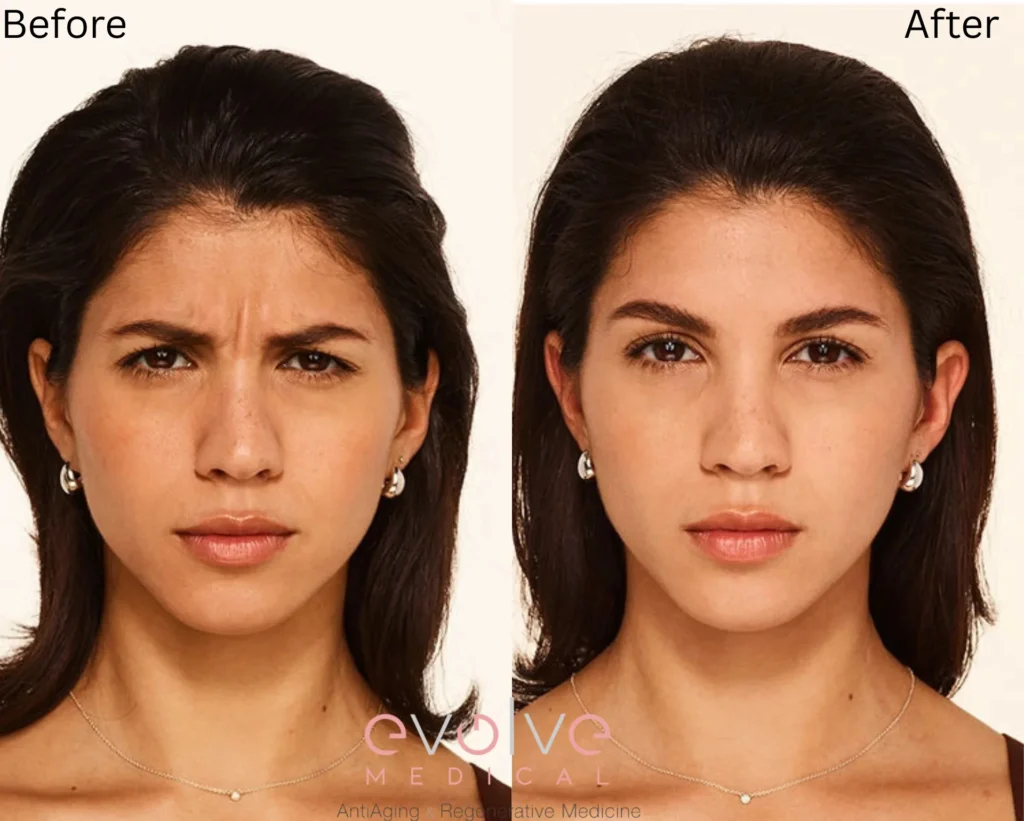 nicole before after botox