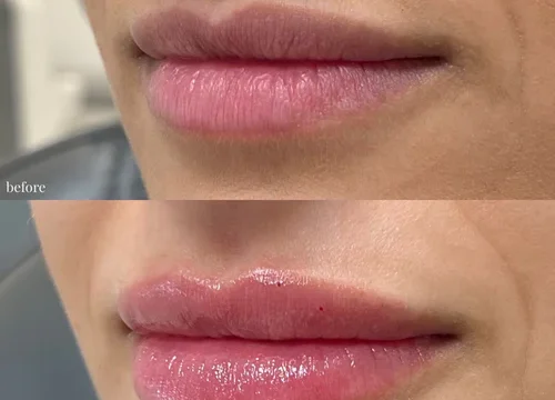 jana lip filler 1