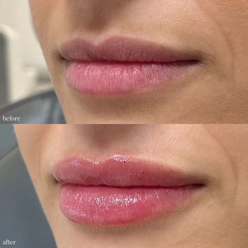 Lip Filler Before and After
