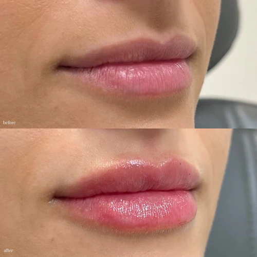 jana lip filler