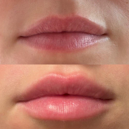 race lip filler