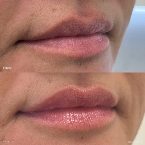 saor lip filler