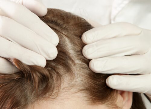 5 Causes Of Thinning Hair and What Actually Works