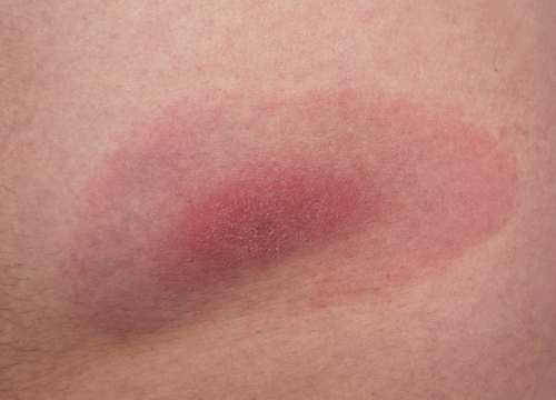 EBO2 for Lyme Disease: A Closer Look at Ozone Therapy for Chronic Lyme