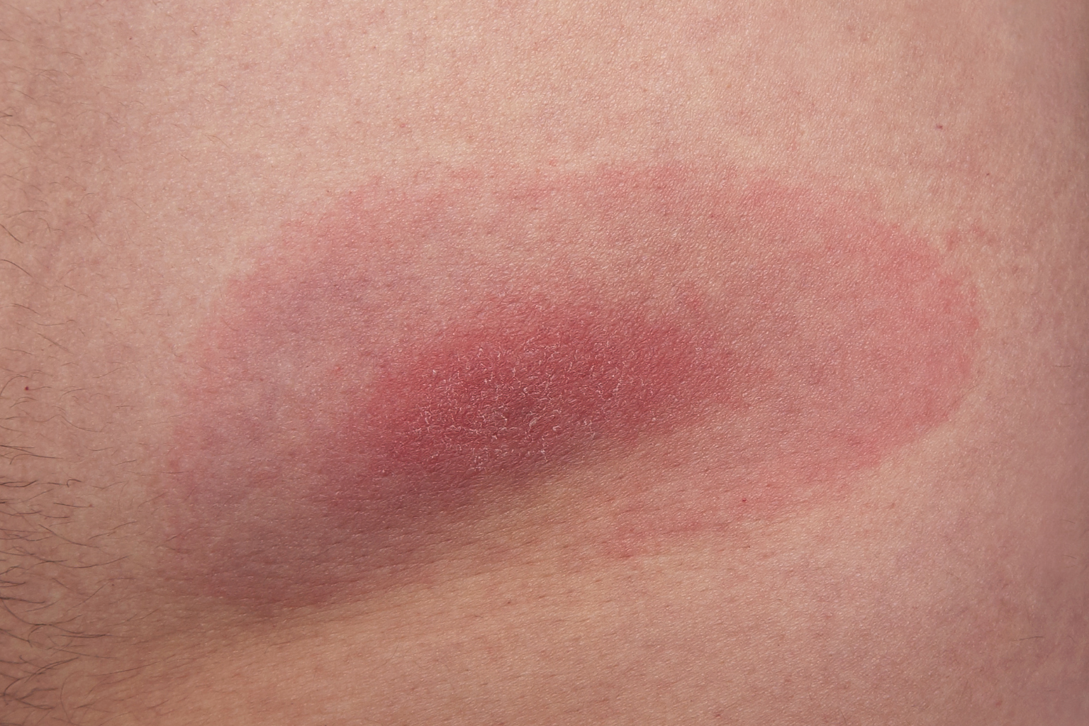 EBO2 for Lyme Disease: A Closer Look at Ozone Therapy for Chronic Lyme