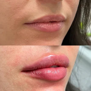 sf lip filler